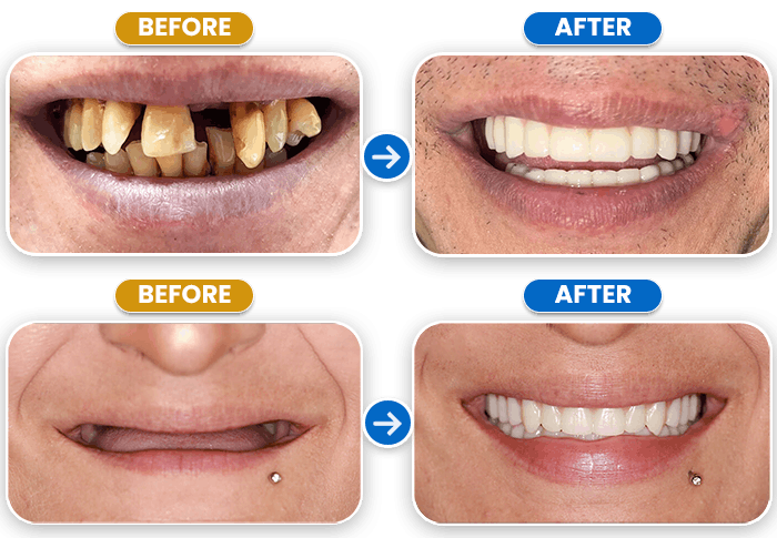 Implant dentiistry - Before After